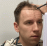 Семичасовая операция и уколы в голову: кировский ведущий сделал пересадку волос - ProGorod.Ru