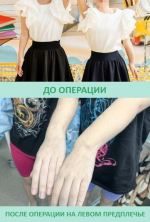 У 13-летних сестёр из Республики Коми два-три года назад начала проявляться болезнь Маделунга, или «штыкообразная кисть», приводящая к деформации предплечья, лучезапястного сустава и кисти.